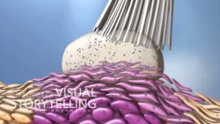 Actinic Keratosis Mode of Action Animation [upl. by Akehsal]