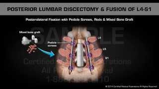 Posterior Lumbar Discectomy amp Fusion of L4S1 [upl. by Ttergram]