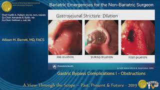 Gastric Bypass Complications I  Obstructions [upl. by Akinuahs]