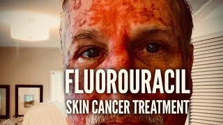 Fluorouracil Skin Treatment  Before During and After [upl. by Lauralee471]