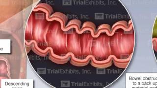 Bowel Perforation [upl. by Sugihara]