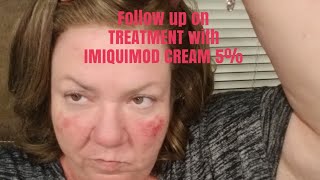 Follow up on Treatment with IMIQUIMOD CREAM 5 [upl. by Marino]