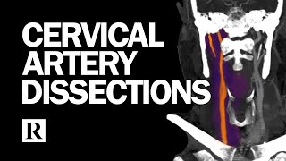 Cervical Arterial Dissections [upl. by Odel500]