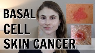 BASAL CELL SKIN CANCER WHAT YOU SHOULD KNOW DR DRAY [upl. by Onofredo]