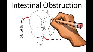 Intestinal Obstruction  Part 1 [upl. by Arbe]