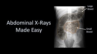 Abdominal XRays Made Easy [upl. by Atiekram]