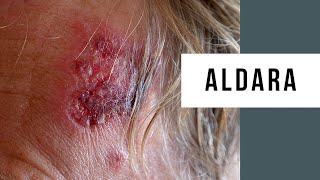 Skin Cancer Treatment Using Aldara Cream [upl. by Herbst]