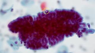 Cervical cytology  Endocervical cells [upl. by Friederike]