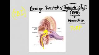 Urinary Obstruction and BPH [upl. by Conyers]