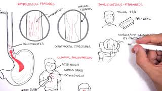 GORD GERD Gastro Oesophageal Reflux Disease  Overview pathophysiology treatment [upl. by Melisandra]