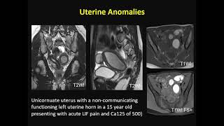 ISMRM MR Academy  Endometrial and Cervical Cancer [upl. by Shadow388]