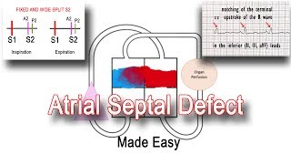 Atrial Septal Defect ASD Pathophysiology amp Clinical Features [upl. by Tildie]