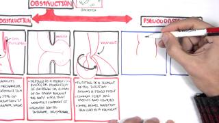 Bowel Obstruction  Causes and Pathophysiology [upl. by Nhoj200]