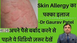 स्किन ऐलर्जी का इलाज।Skin Allergy Treatment At Home By Dermatologist Dr Gaurav Patel skinallergy [upl. by Francyne432]