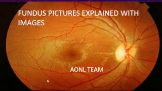 Fundus images explained by an ophthalmologist [upl. by Katie]